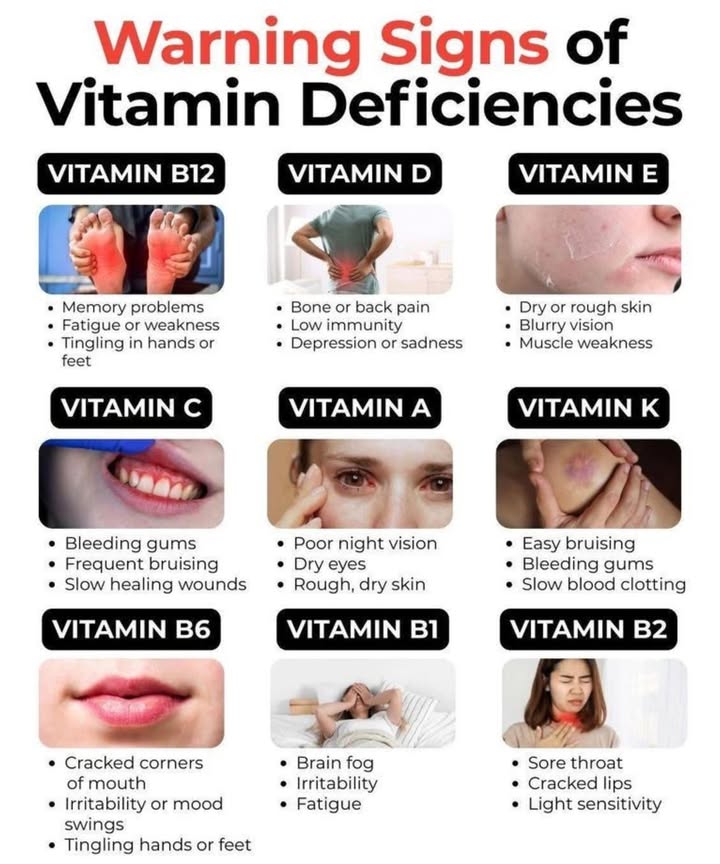 Warning Signs of Vitamin Deficiencies You Shouldnt Ignore!
易 VITAMIN B12
Signs You Might Be Deficient:

Memory problems

Fatigue or weakness

Tingling in hands or feet

 Tip: Add more eggs, dairy, meat, or B12-fortified foods to your diet.

 VITAMIN D
Warning Symptoms:

Bone or back pain

Low immunity

Depression or sadness

 Tip: Get sunlight daily, eat fatty fish, or consider a supplement.

 VITAMIN E
Deficiency Indicators:

Dry or rough skin

Blurry vision

Muscle weakness

 Tip: Snack on almonds, sunflower seeds, and leafy greens.

 VITAMIN C
Look Out For:

Bleeding gums

Frequent bruising

Slow healing wounds

 Tip: Citrus fruits, bell peppers, and broccoli are great sources!

 VITAMIN A
Telltale Signs:

Poor night vision

Dry eyes

Rough, dry skin

 Tip: Include carrots, sweet potatoes, and spinach in meals.

喝 VITAMIN K
Common Symptoms:

Easy bruising

Bleeding gums

Slow blood clotting

 Tip: Eat kale, spinach, and broccoli to boost intake.

 VITAMIN B6
What to Watch For:

Cracked corners of mouth

Irritability or mood swings

Tingling hands or feet

 Tip: Add bananas, poultry, and chickpeas to your plate.

 VITAMIN B1 Thiamine
Deficiency Signs:

Brain fog

Irritability

Fatigue

 Tip: Whole grains, pork, and legumes can help!

 VITAMIN B2 Riboflavin
Symptoms You May Notice:

Sore throat

Cracked lips

Light sensitivity

 Tip: Enjoy dairy, eggs, and fortified cereals.