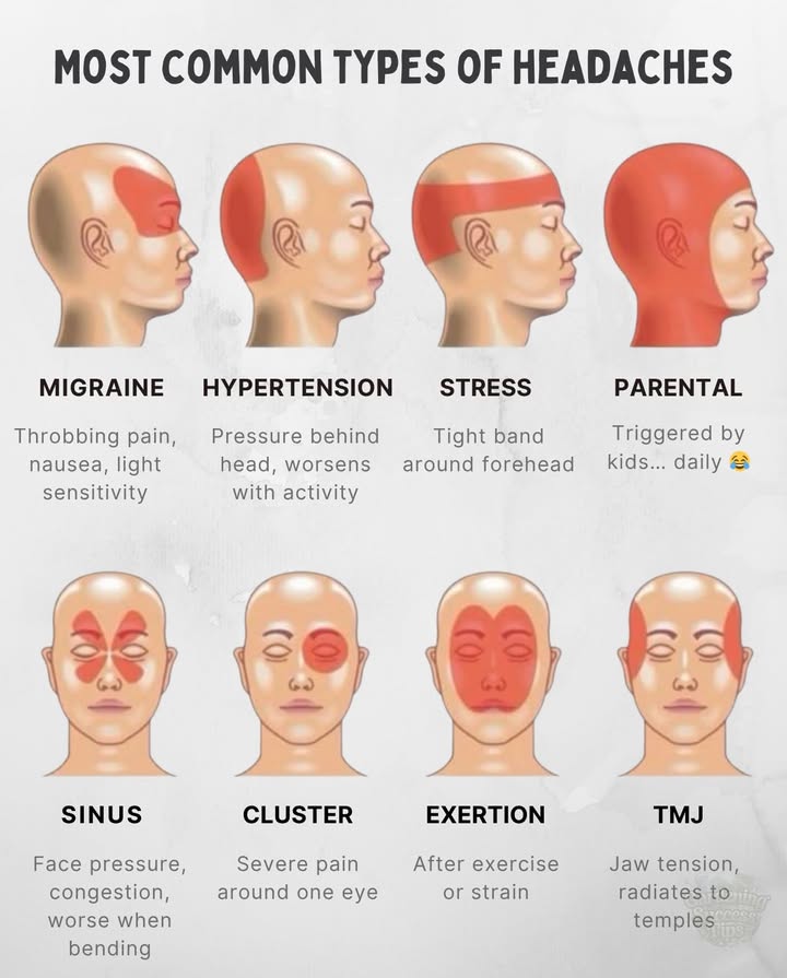 Most Common Types of Headaches & Where They Hurt

 Migraine
Where: One side of the head, behind the eye, or temple
Feels Like: Throbbing, intense pain
Other Signs: Nausea, light and sound sensitivity

 Hypertension Headache
Where: Back of the head
Feels Like: Dull, pulsing pain
Note: Worse in the morning, linked to high blood pressure

 Stress Tension Headache
Where: Forehead, temples, or like a band around the head
Feels Like: Constant pressure or tightness
Also Called: Tight band headache

 Parental Headache
Where: Whole head
Feels Like: Fatigue-induced, dull ache
Caused By: Stress, lack of sleep, mental overload

 Sinus Headache
Where: Forehead, eyes, cheeks
Feels Like: Pressure and tenderness
Other Signs: Nasal congestion, fever

 Cluster Headache
Where: Behind one eye or on one side
Feels Like: Excruciating, stabbing pain
Other Signs: Tearing, nasal stuffiness, eyelid droop

 Exertion Headache
Where: Whole head
Feels Like: Sudden pressure or pain after activity
Triggers: Exercise, coughing, heavy lifting

 TMJ Headache
Where: Temples, jaw, ears, neck
Feels Like: Achy pain, jaw clicking or tightness
Cause: Jaw joint and muscle tension

 When to See a Doctor
Seek help if your headache is:
 Sudden and severe
 Comes with vision issues or numbness
 Persistent or worsening over time