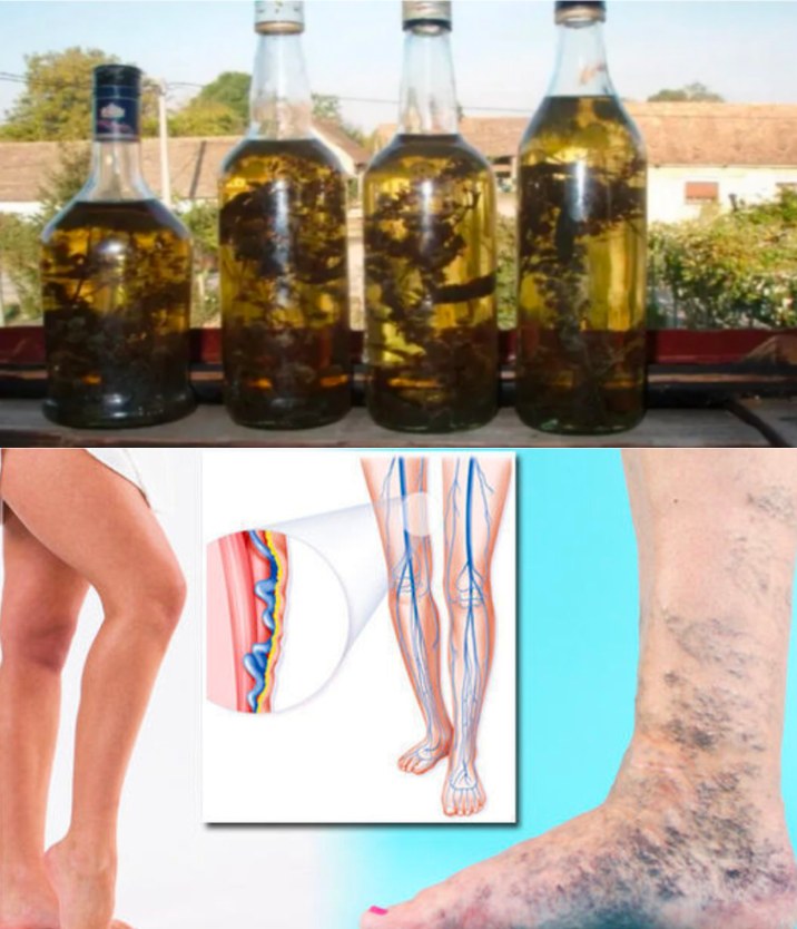 A Traditional Russian Recipe to Enhance Blood Circulation: Effective in Reducing Varicose and Inflamed Veins! 
-Ingredients:
1 quart of brandy
1 ounce of fresh rosemary
-Instructions:
Place the fresh rosemary in a container with the brandy.
Let it steep for 10 days to allow the rosemary to infuse into the brandy.
-Application:
1.After the 10-day infusion period, the remedy is ready for use in massages and vein dressings.
2.Apply the brandy infused with rosemary to the painful veins and gently massage two to three times a day for about fifteen minutes.
3.For better results, you can use a small amount of oil during the massage.
4. You can also create overnight compresses by soaking cotton cloth in the brandy and rosemary mixture and wrapping your legs with it.
5.Regularly using this brandy and rosemary remedy can help alleviate leg cramps, improve blood circulation, and reduce leg inflammation.
6.Consistency is key, so make sure to incorporate daily compresses and massages into your routine.
-Note:
Rosemary is not only beneficial for treating varicose veins but also for prevention. You can replace the rosemary sprigs in the container with fresh ones as needed, discarding the old ones.
In addition to its vein-healing properties, rosemary is known for its positive effects on concentration and memory. You can also explore rosemary essential oil for additional therapeutic benefits.