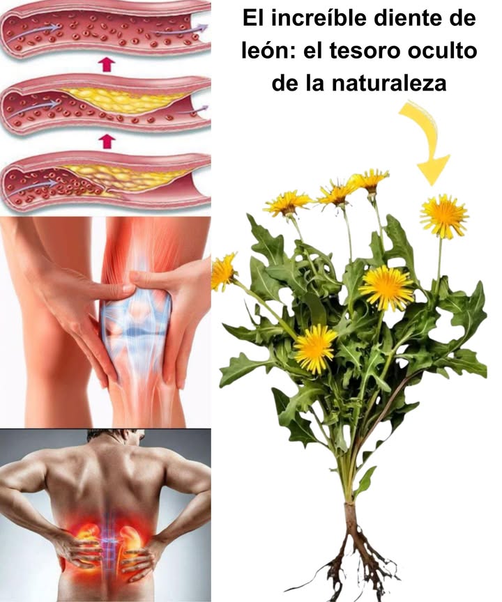 El increíble diente de león: el tesoro oculto de la naturaleza 

El diente de león Taraxacum officinale es más que una simple maleza. Desde su raíz hasta su flor, esta planta silvestre se considera un superalimento, con siglos de uso en la medicina tradicional. Sus propiedades depurativas, digestivas y nutritivas lo convierten en un aliado natural esencial.

 30 beneficios del diente de león
 Antioxidante natural  
 Fortalece las defensas  
 Mejora la digestión y reduce la hinchazón  
 Realiza una limpieza hepática profunda  
 Diurético suave y efectivo  
 Regula los niveles de azúcar en sangre  
 Apoya la salud renal  
 Facilita la pérdida de peso  
 Rico en vitaminas A, C y K  
 Beneficia la piel desde adentro  
 Fortalece los huesos  
 Previene infecciones urinarias  
 Tiene efecto antiinflamatorio  
 Combate la anemia  
 Equilibra las hormonas femeninas  
 Estimula el crecimiento del cabello  
 Protege la salud visual  
 Desintoxica la vesícula biliar  
 Aumenta la energía naturalmente  
 Mejora la salud cardiovascular  
 Disminuye el colesterol LDL  
 Potencial anticancerígeno  
 Retrasa el envejecimiento celular  
 Alivia eccema y psoriasis  
 Reduce el dolor articular  
 Fortalece dientes y encías  
 Mejora la memoria y concentración  
 Estimula el metabolismo  
 Combate bacterias  
 Previene cálculos biliares  

 Cómo usarlo en casa
 Hojas: en ensaladas, salteadas o en infusiones.  
 Flores: para tés, aceites o vinos medicinales.  
 Raíz: seca y tostada como café o en tinturas.  

 Precauciones
Evitar en caso de alergia a la ambrosía, si se utilizan anticoagulantes, diuréticos o se padece diabetes. Consulta a un especialista si hay problemas biliares.

 Conclusión natural
Un regalo de la naturaleza que limpia, nutre y fortalece. Ya sea en una taza, un plato o en tu rutina de cuidado personal, el diente de león merece un lugar especial en tu vida.
