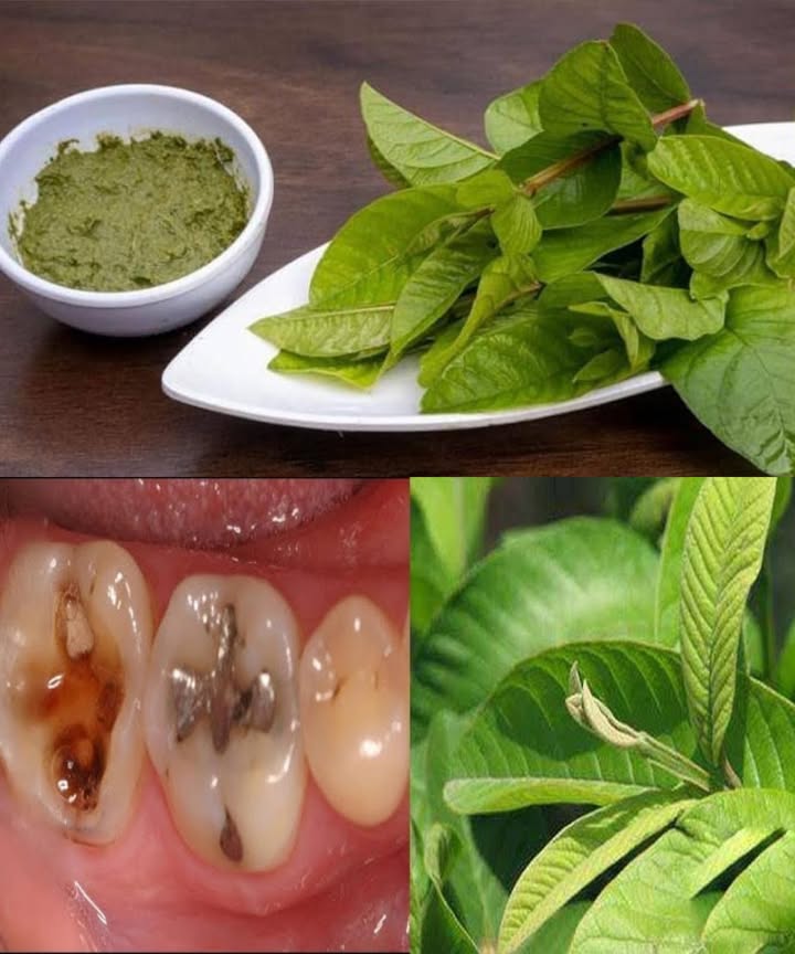 Las 3 mejores maneras de tratar la caries dental con hojas de guayaba: sencillas y económicas 

Cuando pensamos en la guayaba, solemos imaginarnos su dulce fruta tropical . Pero pocos saben que las hojas del guayabo son igual de eficaces para la salud bucal. Ricas en compuestos antibacterianos, antiinflamatorios y antioxidantes, se han usado durante siglos para aliviar el dolor de muelas, refrescar el aliento y mantener las encías sanas.

瘟 Aunque no reemplazan la atención dental profesional, las hojas de guayaba son un remedio natural, sencillo y económico para mantener dientes y encías fuertes en casa.

 1 Masticar hojas frescas de guayaba
El método más simple y antiguo.
 Toma 2 o 3 hojas tiernas y limpias.
 Lávalas bien con agua.
 Mastícalas lentamente unos minutos.

 Cómo actúa:
Sus flavonoides y taninos combaten las bacterias que causan caries, refrescan el aliento y calman el dolor dental leve.

 2 Enjuague bucal casero de hojas de guayaba
Perfecto si no quieres masticarlas directamente.
北 Hierve 5 a 7 hojas en una taza de agua durante 10 min.
 Cuela y deja enfriar hasta que esté tibio.
𧻓 Usa el líquido como enjuague bucal 1 o 2 veces al día.

 Cómo actúa:
Funciona como un antimicrobiano natural, reduce la placa, combate el mal olor y desinflama las encías sin alterar el equilibrio bucal.

 3 Pasta de hojas de guayaba con sal
Una opción práctica para aplicar directamente.
蓼 Machaca varias hojas frescas con un poco de agua.
Agrega una pizca de sal y mezcla.
Aplica la pasta sobre los dientes o encías, deja 5 min y enjuaga.

 Cómo actúa:
La combinación de guayaba y sal reduce infecciones leves, alivia la sensibilidad y frena los primeros signos de caries.

 Las hojas de guayaba son más que un subproducto del árbol frutal: son un aliado natural para la salud bucal. Ya sea masticadas, enjuagadas o aplicadas como pasta, ayudan a combatir bacterias, reducir inflamaciones y aliviar molestias.

醴 Úsalas como parte de tu rutina preventiva junto con el cepillado, el hilo dental y las revisiones regulares.