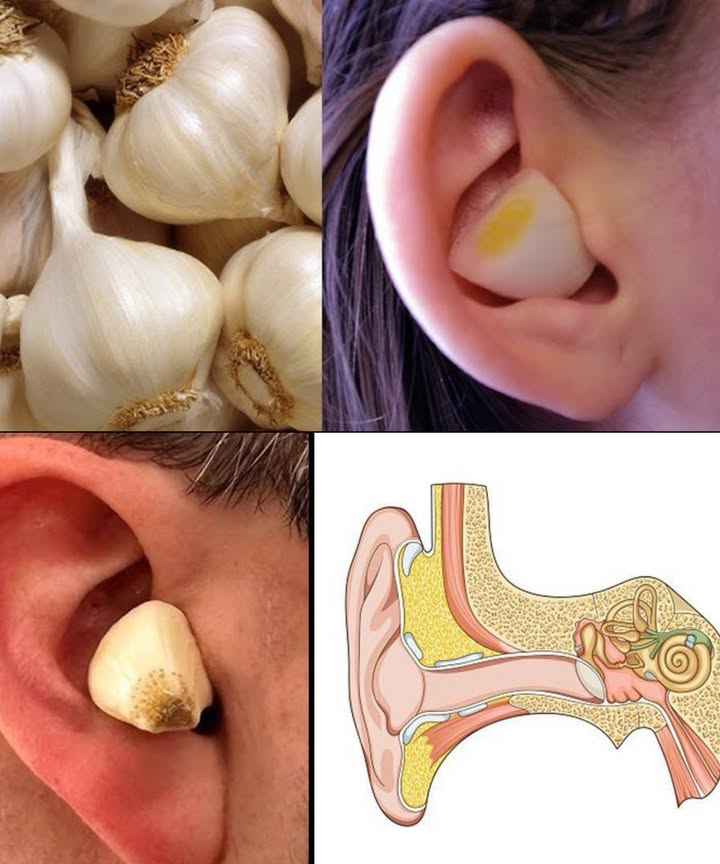 龍 Ajo para la salud auditiva: alivio natural

El ajo, conocido por sus propiedades antibacterianas, antifúngicas y antiinflamatorias, se convierte en un aliado natural para los oídos. Ideal para dolores leves, infecciones o exceso de cerumen, sin químicos agresivos.

 Beneficios principales

Alivia infecciones leves de oído

Reduce inflamación y dolor

Ablanda y facilita la eliminación de cera

Combate hongos como Candida

Mantiene higiene y salud general del canal auditivo

 Formas de uso

Aceite de ajo para gotas

12 dientes de ajo  2 cucharadas de aceite de oliva o coco

Cocinar a fuego lento 510 min hasta dorar ligeramente

Colar y enfriar

Aplicar 12 gotas tibias en el oído, 510 min, 12 veces al día, máximo 3 días

Compresa tibia de ajo

1 diente de ajo machacado envuelto en gasa

Calentar cerca de toalla tibia

Colocar junto al oído, 1015 min

No introducir directamente en el canal

 Precauciones

No usar si hay tímpano roto

Evitar introducir ajo directamente en el oído

Usar aceite tibio, nunca caliente

Consultar médico si los síntomas persisten o empeoran

 El ajo es un remedio natural eficaz para aliviar dolor, infecciones y mantener la salud auditiva, combinando tradición y ciencia en cada gota y compresa.