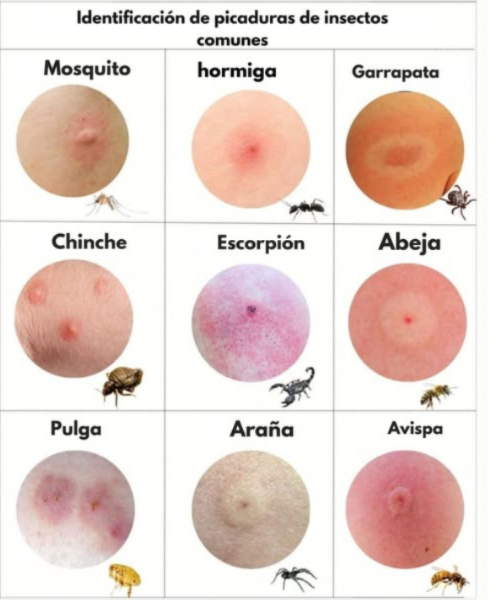 Identifica las picaduras más comunes de insectos con esta guía visual! 烈  
Te has despertado alguna vez con una ronchita y te preguntas qué insecto fue el responsable? Esta imagen puede ayudarte a reconocer el tipo de picadura según su apariencia y el insecto que la causó.   
烈 Mosquito: Picadura redonda y elevada, suele ser más activa por la noche.  
 Hormiga: Enrojecida y con un centro irritado, a veces provoca ardor.  
 Garrapata: Mancha con un anillo rojo alrededor; requiere atención médica inmediata!  
 Chinche de cama: Varias picaduras pequeñas, a menudo dispuestas en línea.  
廬 Alacrán: Área muy inflamada y rojiza, con dolor intenso.  
 Abeja: Punción en el centro con hinchazón; puede dejar el aguijón.  
 Pulga: Picaduras agrupadas que causan mucha picazón.  
 Araña: Dos puntos centrales con enrojecimiento alrededor.  
 Avispa: Inflamación notable, ardor y fuerte enrojecimiento.  
 Consejo útil: Si experimentas hinchazón extrema, fiebre o dificultad para respirar, busca atención médica de inmediato. Algunas reacciones pueden ser graves!  
#PicadurasDeInsectos #SaludNatural #Chinches