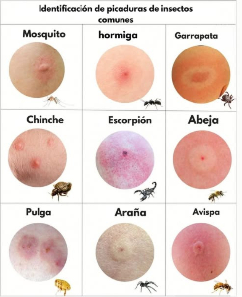 Identifica las picaduras más comunes de insectos con esta guía visual! 烈  
Te has despertado alguna vez con una ronchita y te preguntas qué insecto fue el responsable? Esta imagen puede ayudarte a reconocer el tipo de picadura según su apariencia y el insecto que la causó.   
烈 Mosquito: Picadura redonda y elevada, suele ser más activa por la noche.  
 Hormiga: Enrojecida y con un centro irritado, a veces provoca ardor.  
 Garrapata: Mancha con un anillo rojo alrededor; requiere atención médica inmediata!  
 Chinche de cama: Varias picaduras pequeñas, a menudo dispuestas en línea.  
廬 Alacrán: Área muy inflamada y rojiza, con dolor intenso.  
 Abeja: Punción en el centro con hinchazón; puede dejar el aguijón.  
 Pulga: Picaduras agrupadas que causan mucha picazón.  
 Araña: Dos puntos centrales con enrojecimiento alrededor.  
 Avispa: Inflamación notable, ardor y fuerte enrojecimiento.  
 Consejo útil: Si experimentas hinchazón extrema, fiebre o dificultad para respirar, busca atención médica de inmediato. Algunas reacciones pueden ser graves!  
#PicadurasDeInsectos #SaludNatural #Chinches