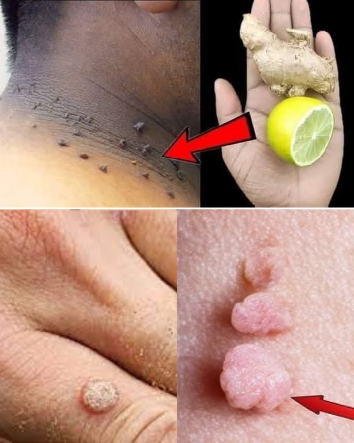 Dites adieu aux acrochordons naturellement : la méthode douce au citron et gingembre