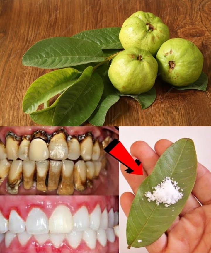 Guava leaves: a natural aid for teeth and gums 醴

Guava leaves have long been valued in traditional care. With their antibacterial, anti-inflammatory, and refreshing qualities, they can support your daily oral hygiene. Here are three easy and affordable ways to use them:

1 Chewing fresh leaves
 Select 23 young, clean leaves
 Chew them slowly for a few minutes
 Helps ease pain, reduce swelling, and freshen breath

2 Homemade mouth rinse
 Boil 57 leaves in 1 cup of water for 10 minutes
 Strain and let cool
 Use as a rinse once or twice daily
 Reduces plaque, fights bacteria, and soothes gums

3 Leaf and salt paste
 Crush fresh leaves into a paste
 Add a small pinch of salt
 Apply to the tooth or gums for 5 minutes, then rinse
 Cleanses, reduces sensitivity, and has antibacterial action

 While not a substitute for professional dental care, guava leaves can complement brushing and regular oral hygiene.