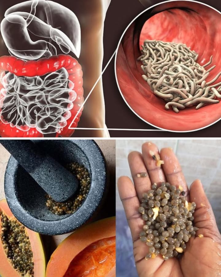 Les graines de papaye contre les parasites intestinaux 

1 Action antiparasitaire : les graines de papaye contiennent des enzymes comme la papaïne qui aident à éliminer les vers intestinaux naturellement.

2 Détox digestive : en plus de chasser les parasites, elles nettoient le système digestif et favorisent une meilleure assimilation des nutriments.

3 Utilisation simple : on peut les mâcher crues goût un peu piquant, comme le poivre ! ou les écraser pour les mélanger à du miel.

 Erreur fréquente : en consommer en trop grande quantité dun coup. Elles sont puissantes et peuvent être irritantes, donc mieux vaut les utiliser avec modération.