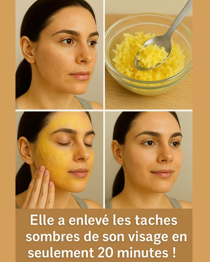 Masque maison pomme de terre & gingembre : le remède naturel anti-taches brunes qui cartonne !