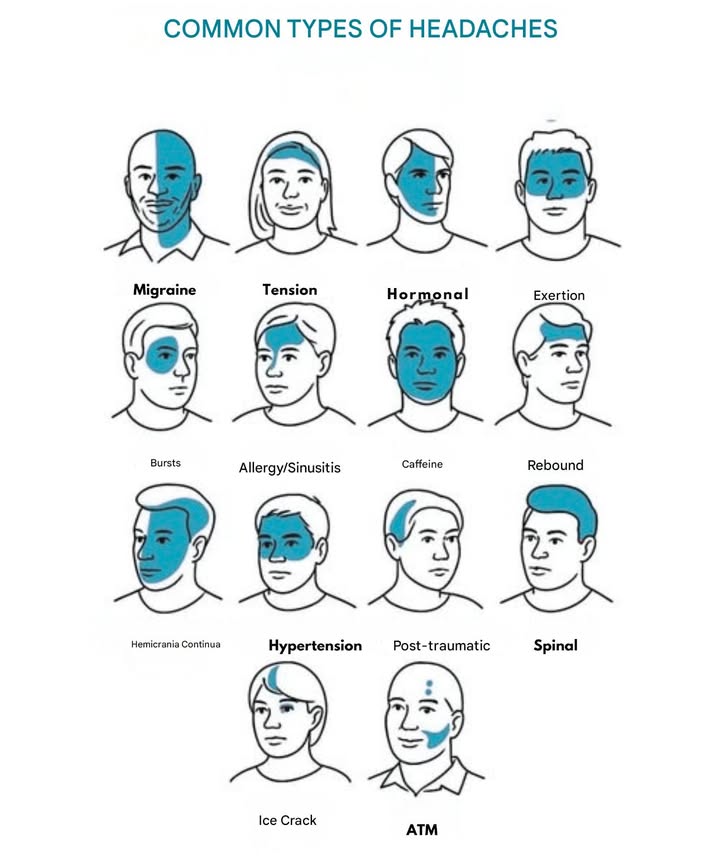 15 Common Types of Headaches  Where and How They Hurt 

Headaches come in many forms, each with its unique sensation and location of pain. Understanding the type can help with proper treatment.

1 Migraine  A throbbing pain on one side, often around the eye.
2 Tension  A tight band-like feeling around the forehead and back of the head.
3 Hormonal  One-sided pain linked to the menstrual cycle.
4 Physical Effort  General headache after intense physical activity.
5 Cluster  Intense pain around one eye, occurring in episodes.
6 Sinus or Allergies  Pressure around the cheeks, eyes, and forehead.
7 Caffeine  Pain in the temples and forehead from too much or too little coffee.
8 Rebound  Headaches caused by overuse of pain relief medication.
9 Chronic Hemicrania  Constant pain on one side of the head.
 Hypertension  Pain at the back and sides of the head due to high blood pressure.
11 Post-Traumatic  Pain localized after a blow to the head.
12 Spinal  Pain in the neck due to cerebrospinal fluid leakage.
13 Thunderclap  Explosive and sudden pain: a medical emergency.
14 Stabbing  Sharp, brief pain in one specific point.
15 TMJ Jaw  Pain around the temples and jaw joint.

易 Extra Tip: Always pay attention to where the pain is located and any accompanying symptoms. This can help determine the best way to alleviate it. If unsure, consult a healthcare professional for guidance.