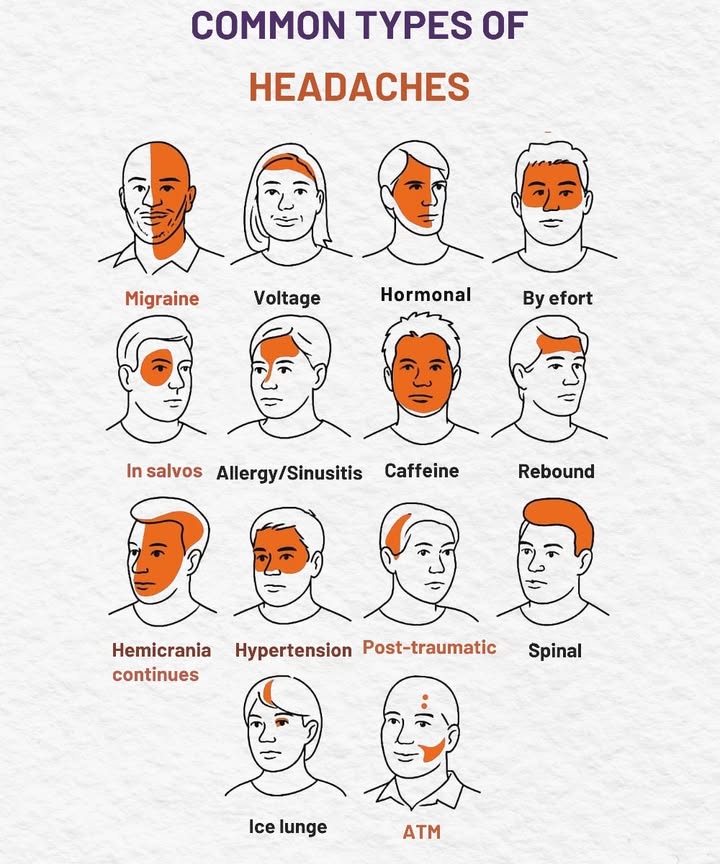 易 Types of Headaches and Their Characteristics 

1 Migraine  Throbbing pain on one side near the eye, often with nausea and light sensitivity.
2 Tension  Tight or pressing sensation around the forehead and neck.
3 Hormonal  Side pain linked to menstrual cycle fluctuations.
4 Exertional  Pain spreading across the head after intense physical activity.
5 Cluster  Severe pain around one eye, appearing in short recurring bursts.
6 Sinus or allergy  Pressure felt in the cheeks, forehead, and around the eyes.
7 Caffeine  Pain in temples or forehead from overuse or withdrawal of caffeine.
8 Rebound  Diffuse pain caused by frequent use of painkillers.
9 Continuous hemicrania  Persistent, one-sided pain lasting for long periods.
 Hypertensive  Pain in the back of the head, often linked to high blood pressure.
11 Post-traumatic  Localized pain appearing after an injury or fall.
12 Spinal  Pain in the neck caused by changes in spinal fluid pressure.
13 Thunderclap  Sudden, severe, and dangerous pain; requires immediate medical care.
14 Ice-pick  Sharp, brief stabbing pain in a specific area of the head.
15 TMJ jaw  Pain in the temple and jaw joint, worsens when chewing.
 Identifying the headache type helps guide the right treatment and prevent future episodes.