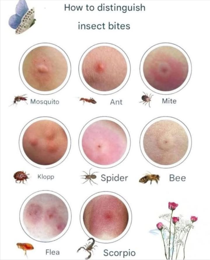 How to Distinguish Insect Bites: A Quick Guide 烈
1. Mosquito 烈

Appearance: Small, raised, red bump.

What to look for: A single, itchy bump that appears after being outdoors.

2. Ant 

Appearance: Red, slightly raised bump with a little dot in the center.

What to look for: Multiple bites in a row, usually indicating an ant attack.

3. Mite 

Appearance: Small, reddish, and sometimes scaly area.

What to look for: A more widespread rash, often after being in a dusty environment.

4. Klopp Chigger 者

Appearance: A small, red, pimple-like bump.

What to look for: The bites typically appear in groups, often in areas like the ankles or waist.

5. Spider 

Appearance: A larger, irritated bump with a central puncture mark.

What to look for: A more painful bite, often with swelling around the area.

6. Bee 

Appearance: A round, swollen bump, sometimes with a stinger left behind.

What to look for: Sharp pain followed by swelling, and possibly a visible stinger.

7. Flea 裂

Appearance: Small, red, and raised with a very itchy feeling.

What to look for: Bites often in clusters, particularly on the lower legs or ankles.

8. Scorpio 廬

Appearance: Larger, more painful bite with a noticeable swelling or bruise.

What to look for: Severe pain and swelling that can last longer.

 Tip: If youre unsure about a bite or experience severe reactions, its always best to consult with a healthcare professional!