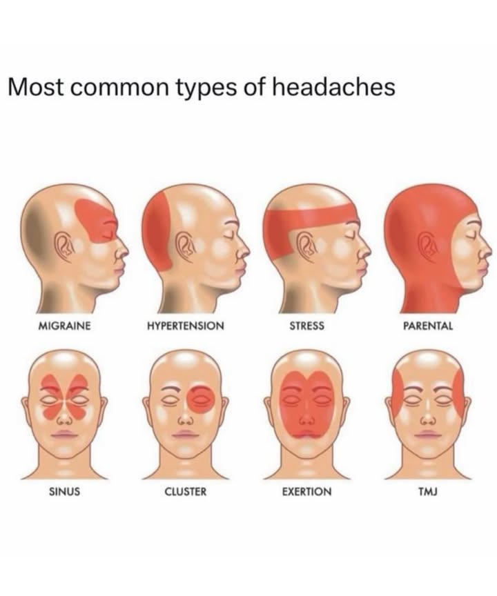 勞 Most Common Types of Headaches & Where They Hurt!
 Migraine
Where: One side of the head, behind the eye, or temple
Feels Like: Throbbing, intense pain
Other Signs: Nausea, light/sound sensitivity

 Hypertension Headache
Where: Back of the head
Feels Like: Dull, pulsing pain
Note: Often worse in the morning; linked to high blood pressure

 Stress Tension Headache
Where: Forehead, temples, or a band around the head
Feels Like: Constant pressure or tightness
Also Called: Tight band headache

 Parental Headache
Where: Generalized, whole head
Feels Like: Fatigue-induced, dull ache
Caused By: Stress, sleep deprivation, mental overload

蠟 Sinus Headache
Where: Around the forehead, eyes, and cheeks
Feels Like: Pressure & tenderness
Other Signs: Nasal congestion, fever

 Cluster Headache
Where: Behind one eye or on one side
Feels Like: Excruciating, stabbing pain
Other Signs: Tearing, nasal stuffiness, eyelid droop

 Exertion Headache
Where: Whole head
Feels Like: Sudden pressure or pain after activity
Triggers: Exercise, coughing, heavy lifting

 TMJ Headache
Where: Temples, jaw, ears, neck
Feels Like: Achy, with jaw clicking or tightness
Cause: Jaw joint and muscle tension

 When to See a Doctor:
Seek help if your headache is:
 Sudden and severe
 Paired with vision issues or numbness
 Persistent or worsening over time