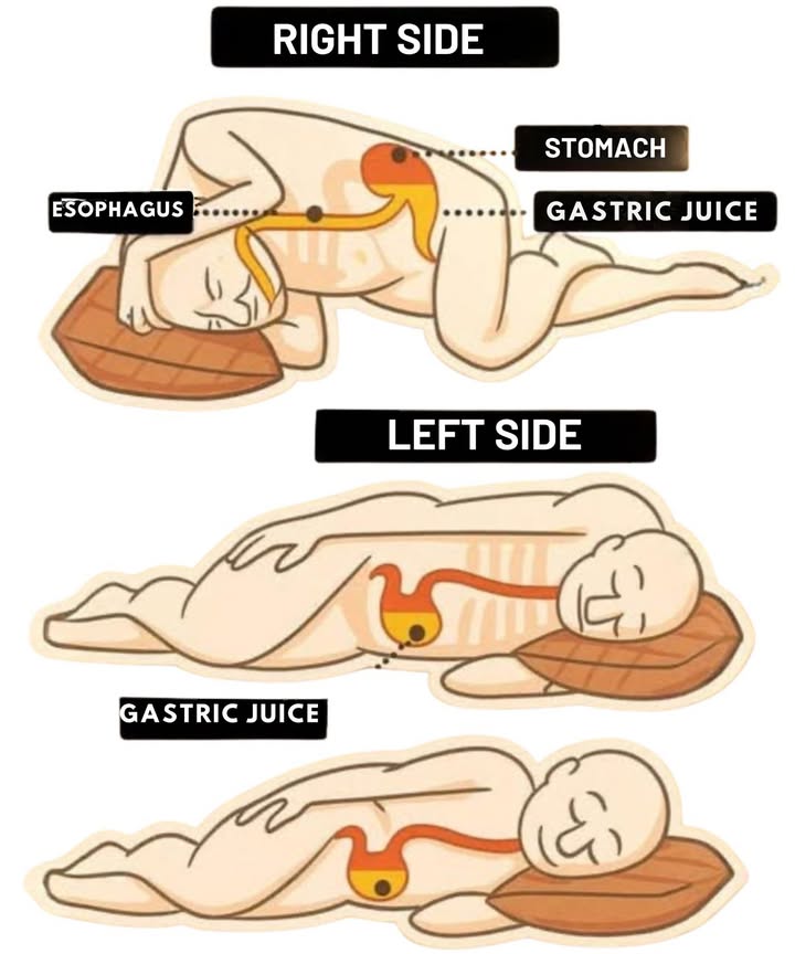 Sleeping on your left side promotes digestion and protects your digestive system.
In this position, the stomach and gastric juices remain lower, preventing reflux into the esophagus.
It also improves circulation, aids lymphatic drainage, and facilitates the hearts workload.
Sleeping on your right side, on the other hand, can cause gastric acids to rise, causing heartburn or stomach discomfort.
A small change in posture can make a big difference for your digestive health and your rest.
