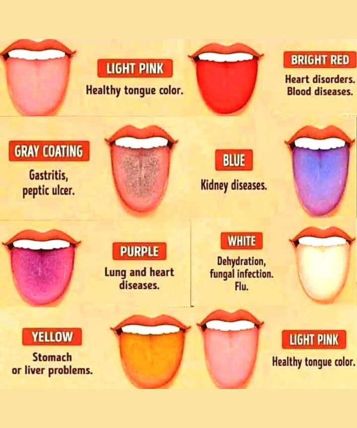 What Your Tongue Color Says About Your Health!
 Bright Red
May signal heart disorders or blood diseases. Its best to check in with your doctor if your tongue turns unusually red!

 Light Pink
The ideal, healthy tongue color. Keep up the good work and stay hydrated!

 Gray Coating
Could be a sign of gastritis or peptic ulcers. Time to take a closer look at your gut health.

 Blue Tongue
Often linked to kidney issues. Dont ignore this rare warning sign.

 Purple Tongue
Potential indicator of lung or heart diseases. Its worth getting a professional opinion.

 White Coating
Common in cases of dehydration, fungal infections, or the flu. Drink up and consider seeing a doctor if it persists.

 Yellow Tongue
May point to stomach or liver problems. Its time for a digestive system check-up!

Your tongue speaks volumesare you listening?
Routine oral checks can help catch early signs of illness. Stay mindful and always consult a healthcare provider for accurate diagnosis. 喙