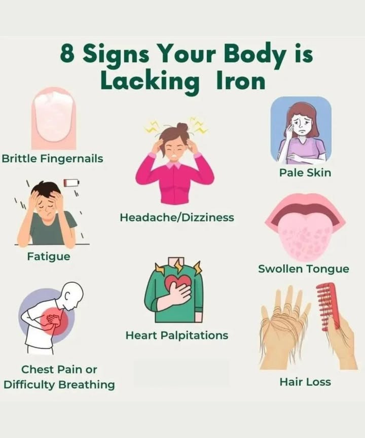 8 Signs Your Body is Lacking Iron  Dont Ignore These! 喝
 Brittle Fingernails
Are your nails splitting, peeling, or breaking easily? Brittle nails are a subtle but early sign that your iron levels might be low.

 Headache/Dizziness
Frequent headaches or feeling light-headed can be your brains way of telling you its not getting enough oxygen.

 Pale Skin
Your skin loses its healthy glow and becomes pale when there isnt enough hemoglobin in your blood.

 Fatigue
Constant tiredness, even after rest? Its one of the most common signs of iron deficiency.

 Swollen Tongue
A smooth, swollen, or unusually sore tongue might be due to a lack of iron.

 Heart Palpitations
Feeling your heart racing or beating irregularly? Low iron can stress your heart as it works harder to circulate oxygen.

 Chest Pain or Difficulty Breathing
Especially during physical activity, this could signal your body isnt getting enough oxygen-rich blood.

林 Hair Loss
Excessive hair fall while brushing or washing could be linked to insufficient iron levels.

 Tip: If you notice one or more of these signs, consult a healthcare provider and consider adding iron-rich foods like spinach, red meat, beans, and fortified cereals to your dietor talk about supplements.