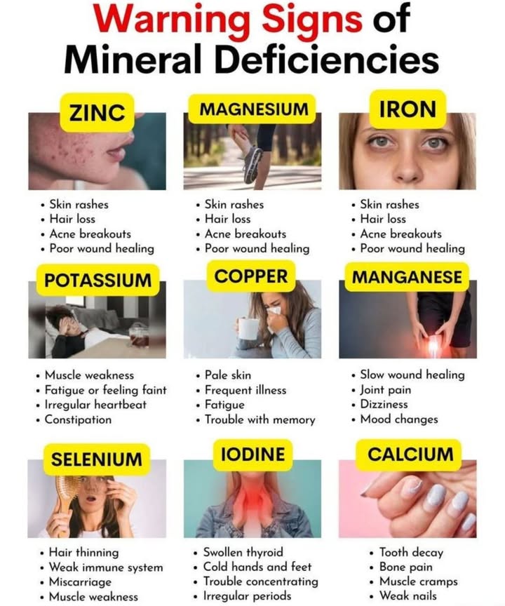 Warning Signs of Mineral Deficiencies 

Your body needs essential minerals to function properly  and when youre low on them, it often sends early signals. Heres what to watch for:

勒 Zinc  Skin rashes, hair loss, acne breakouts, slow wound healing.
 Magnesium  Skin rashes, hair loss, acne breakouts, poor wound healing.
數 Iron  Skin rashes, hair loss, acne breakouts, poor wound healing.
 Potassium  Muscle weakness, fatigue, irregular heartbeat, constipation.
 Copper  Pale skin, frequent illness, fatigue, memory problems.
例 Manganese  Slow wound healing, joint pain, dizziness, mood changes.
 Selenium  Hair thinning, weak immunity, miscarriage risk, muscle weakness.
蓼 Iodine  Swollen thyroid, cold hands and feet, poor concentration, irregular periods.
領 Calcium  Tooth decay, bone pain, muscle cramps, weak nails.

 Tip: A balanced diet rich in fruits, vegetables, nuts, seeds, and lean proteins is the best way to avoid these deficiencies and keep your body running at its best.